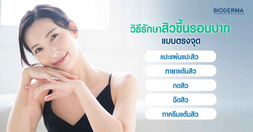 วิธีบรรเทาสิวขึ้นรอบปากแบบตรงจุด