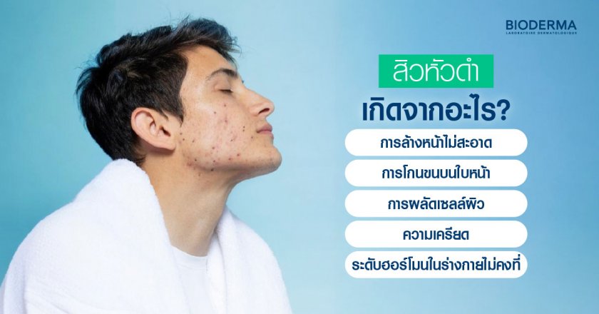 สิวหัวดำเกิดจากอะไร? สาเหตุที่พบบ่อย