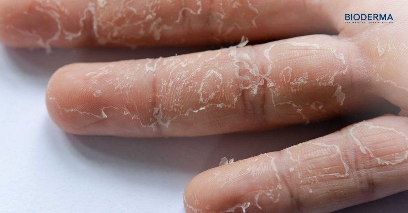 อาการมือลอกคืออะไร?