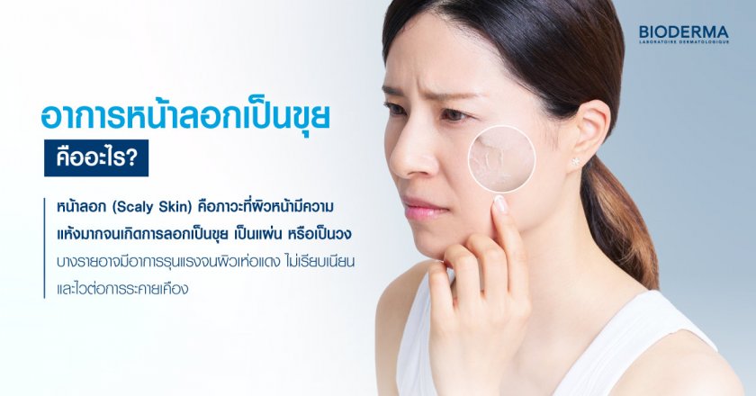 อาการหน้าลอกเป็นขุยคืออะไร?