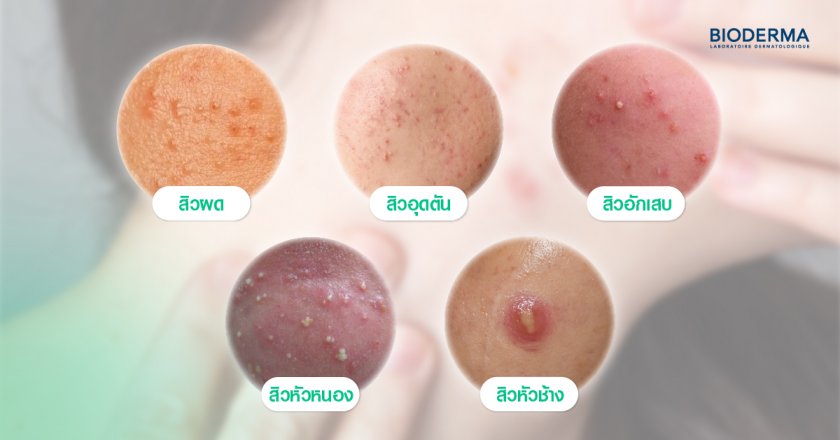 สิวที่คอมีกี่ประเภท?