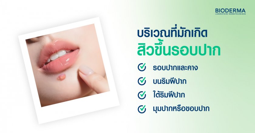 บริเวณที่มักเกิดสิวขึ้นรอบปาก