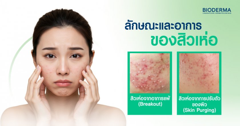 ลักษณะและอาการของสิวเห่อ