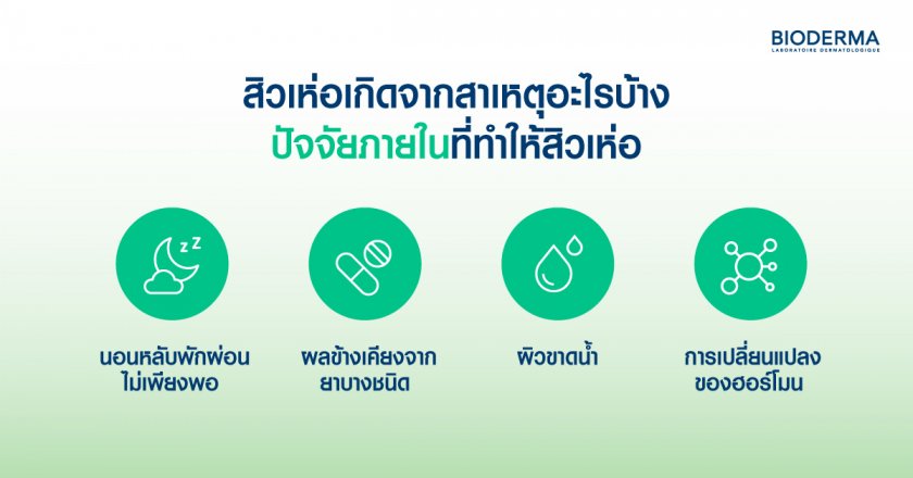 สิวเห่อเกิดจากสาเหตุอะไรบ้าง