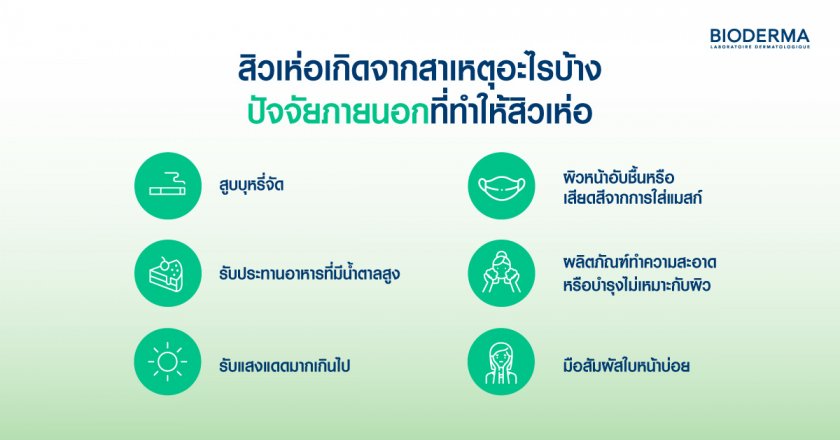 ปัจจัยภายนอกที่ทำให้สิวเห่อ