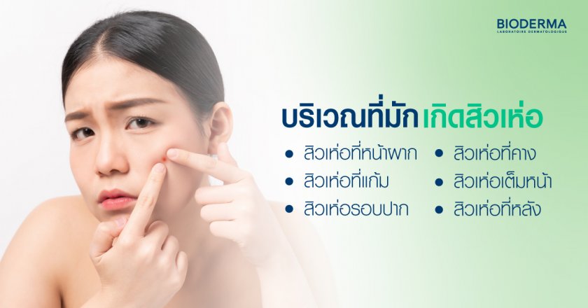 บริเวณที่มักเกิดสิวเห่อ