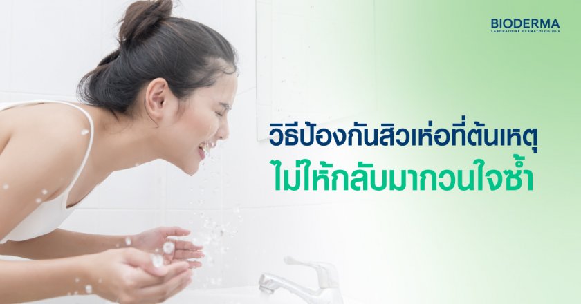 วิธีป้องกันสิวเห่อที่ต้นเหตุ ไม่ให้กลับมากวนใจซ้ำ