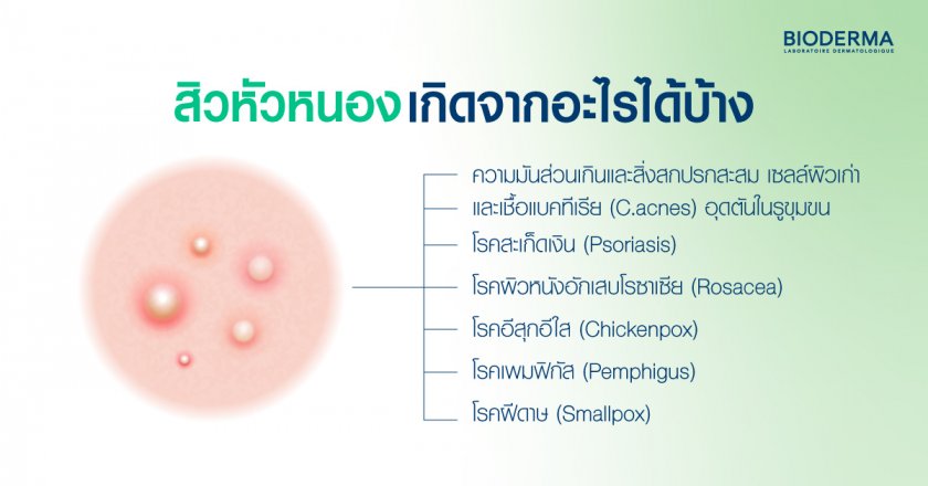 สิวหัวหนองเกิดจากอะไรได้บ้าง