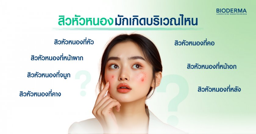 สิวหัวหนองมักเกิดบริเวณไหน