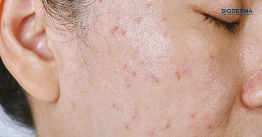 รอยแดงจากสิวเป็นอย่างไร