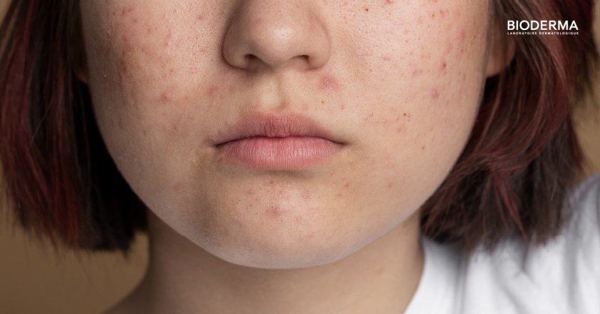 รอยแผลเป็นจากสิว เกิดจากอะไร?