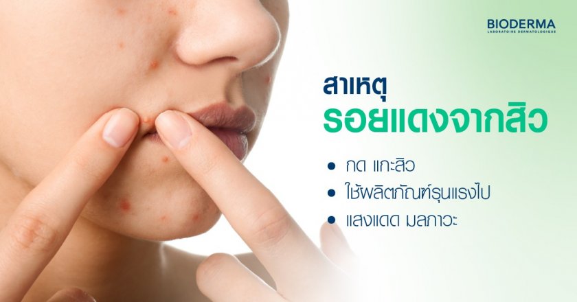 สาเหตุรอยแดงจากสิว