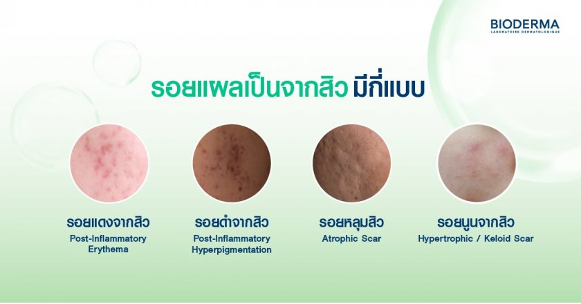 รอยแผลเป็นจากสิวมีกี่แบบ