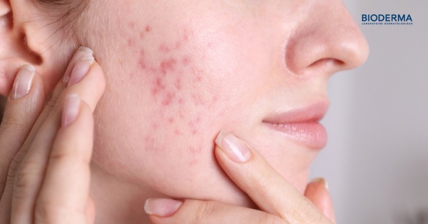 รอยแดงจากสิวหายเองได้ไหม?