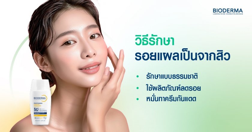 วิธีรักษารอยแผลเป็นจากสิว