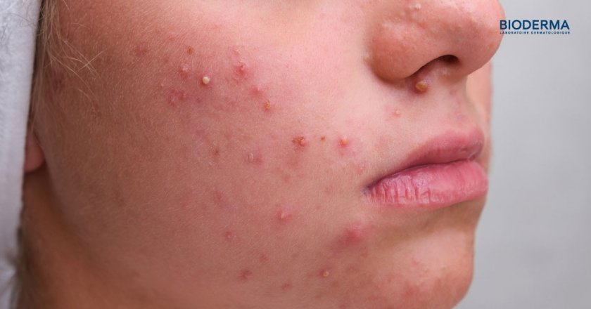 สิวสเตียรอยด์ คืออะไร