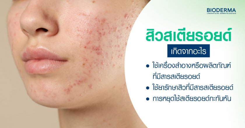 สิวสเตียรอยด์เกิดจากอะไร