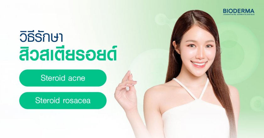วิธีรักษาสิวสเตียรอยด์