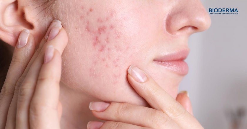 สิว (Acne) คืออะไร?