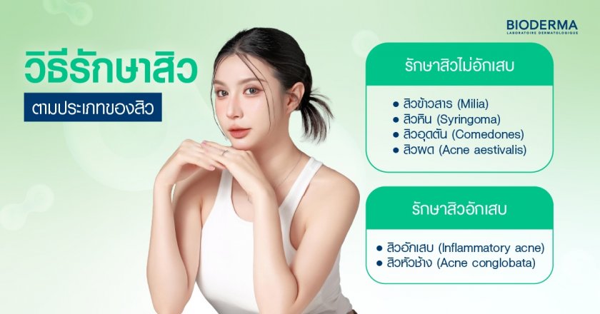 วิธีรักษาสิวตามประเภทของสิว