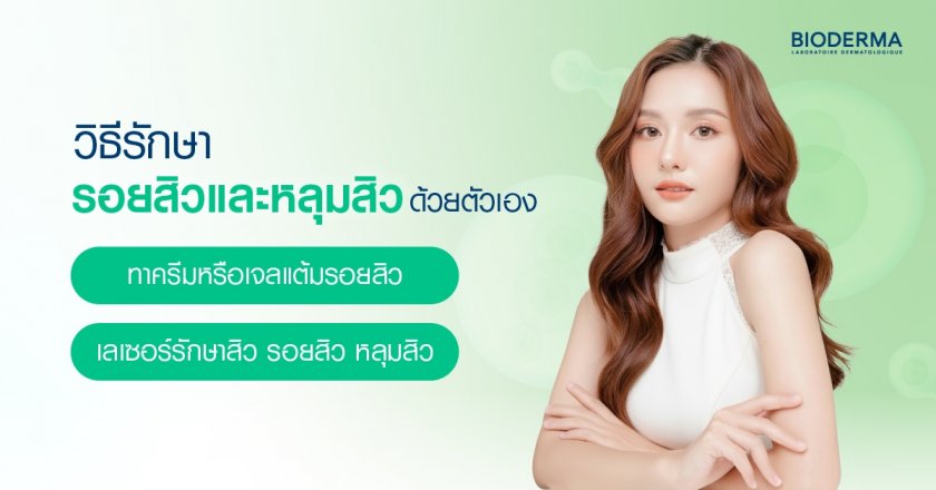 วิธีรักษารอยสิวและหลุมสิวด้วยตัวเอง