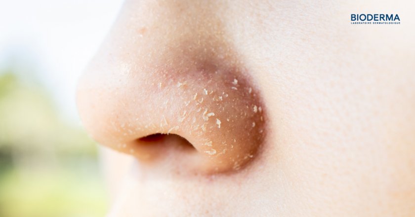 อาการขอบจมูกลอก แสบ คืออะไร?