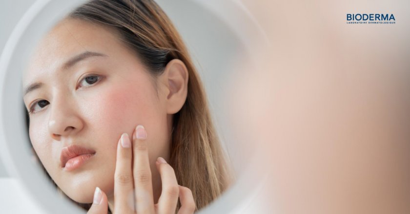 ทำไมผิวแพ้ง่ายต้องใส่ใจเลือกครีมกันแดดเป็นพิเศษ