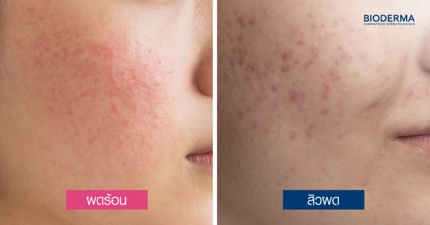 ผดร้อน vs สิวผด เหมือนกันไหม ต่างกันอย่างไร