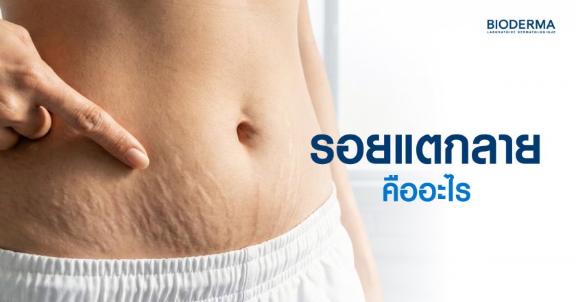 รอยแตกลาย คืออะไร