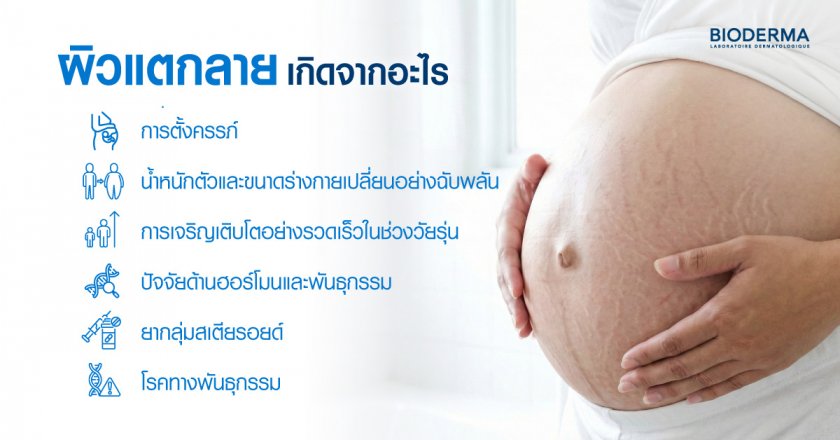 ผิวแตกลายเกิดจากอะไร