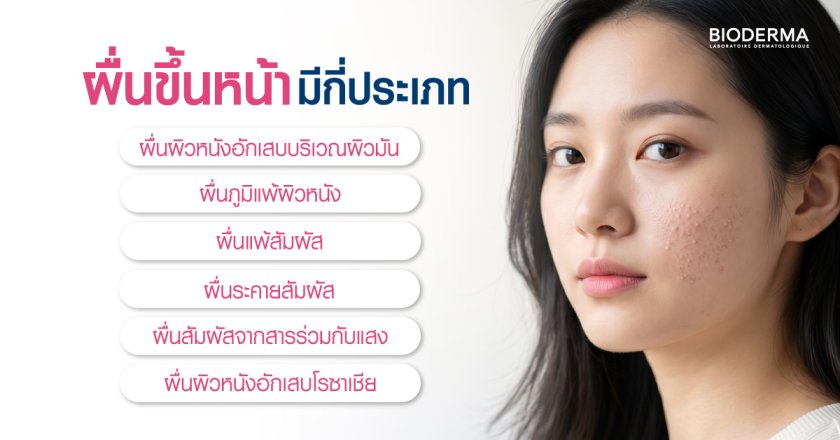 ผื่นขึ้นหน้ามีกี่ประเภท