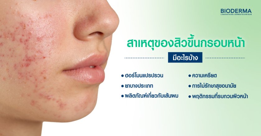 สาเหตุของสิวขึ้นกรอบหน้า มีอะไรบ้าง