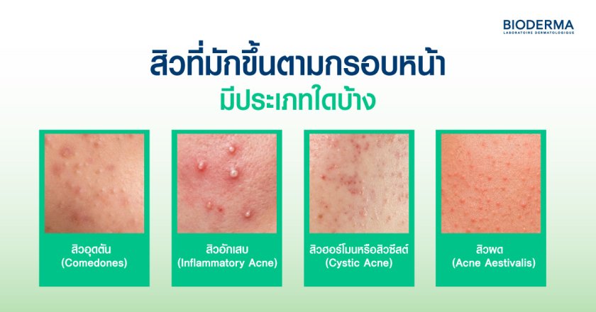 สิวที่มักขึ้นตามกรอบหน้า มีประเภทใดบ้าง