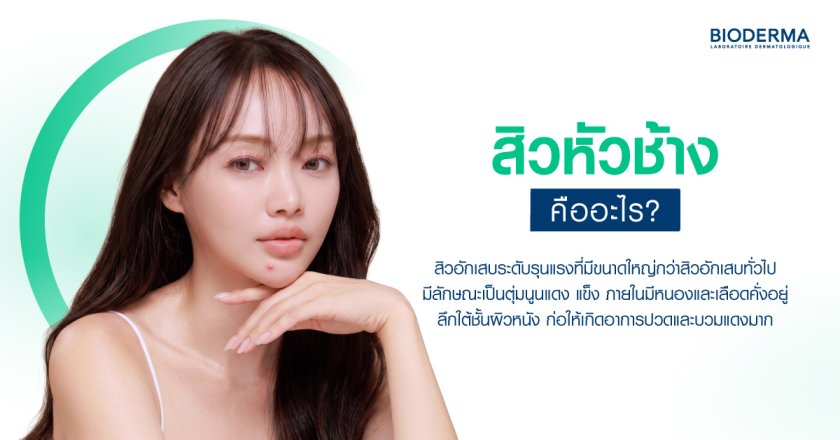 สิวหัวช้างคืออะไร