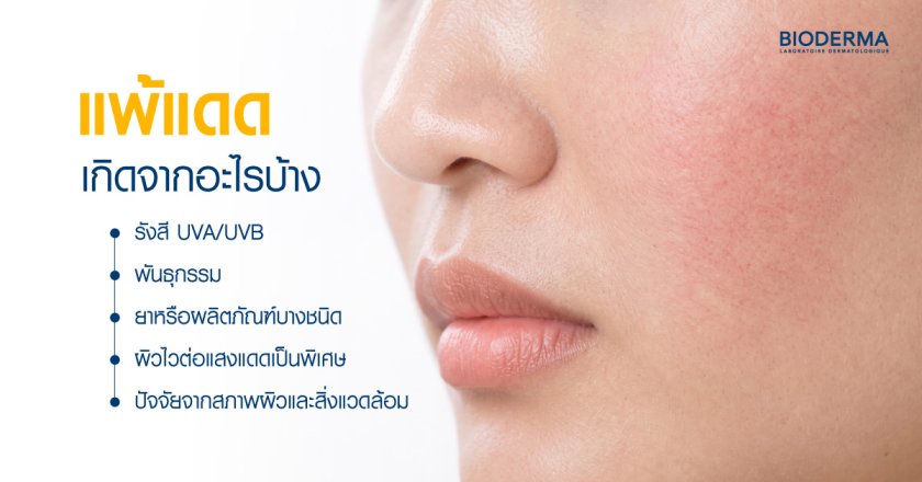 แพ้แดดเกิดจากอะไรบ้าง