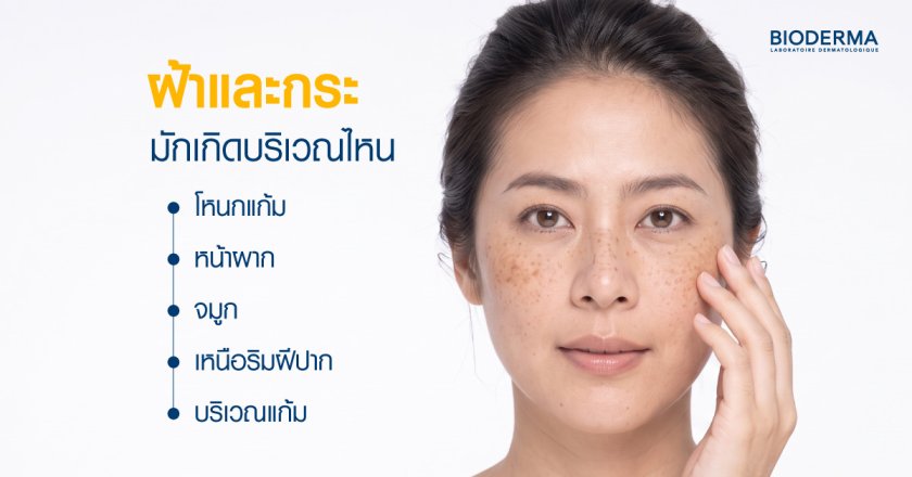 ฝ้าและกระมักเกิดบริเวณไหน