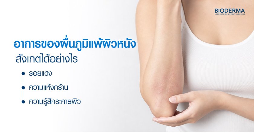 อาการของผื่นภูมิแพ้ผิวหนัง สังเกตได้อย่างไร