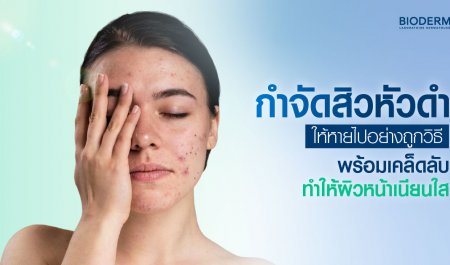 กำจัดสิวหัวดำให้หายไปอย่างถูกวิธี พร้อมเคล็ดลับทำให้ผิวหน้าเนียนใส