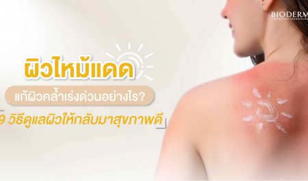 ผิวไหม้แดด แก้ผิวคล้ำเร่งด่วนอย่างไร? 9 วิธีดูแลผิวให้กลับมาสุขภาพดี