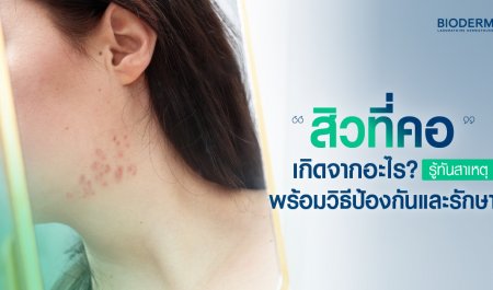 สิวที่คอเกิดจากอะไร? รู้ทันสาเหตุ พร้อมวิธีป้องกันและรักษา