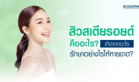 สิวสเตียรอยด์คืออะไร เกิดจากอะไร รักษาอย่างไรให้หายขาด?