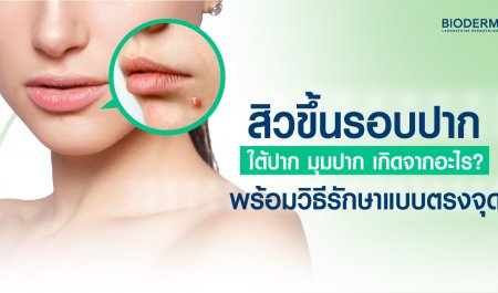 สิวขึ้นรอบปาก ใต้ปาก มุมปาก เกิดจากอะไร? พร้อมวิธีรักษาแบบตรงจุด