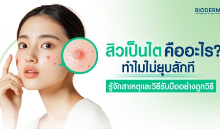 สิวเป็นไตคืออะไร? ทำไมไม่ยุบสักที รู้จักสาเหตุและวิธีรับมืออย่างถูกวิธี