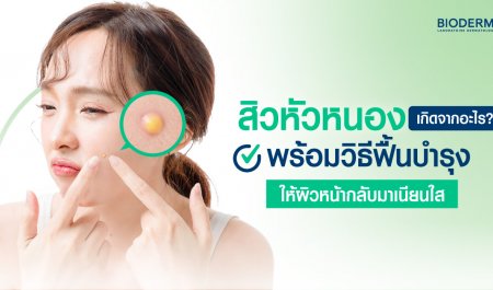 สิวหัวหนองเกิดจากอะไร? พร้อมวิธีฟื้นบำรุงให้ผิวหน้ากลับมาเนียนใส