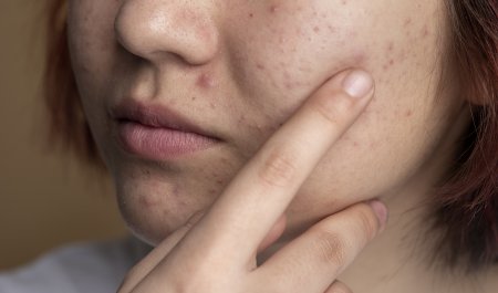 สิวเกิดจากอะไร  สาเหตุที่ทำให้เกิดสิว ลดสิวทำอย่างไร_Bioderma