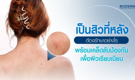 เป็นสิวที่หลังต้องรักษาอย่างไร พร้อมเคล็ดลับป้องกันเพื่อผิวที่เรียบเนียน