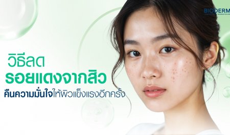 วิธีลดรอยแดงจากสิว คืนความมั่นใจให้ผิวแข็งแรงอีกครั้ง