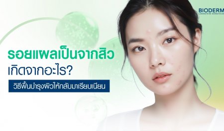 รอยแผลเป็นจากสิวเกิดจากอะไร? วิธีฟื้นบำรุงผิวให้กลับมาเรียบเนียน
