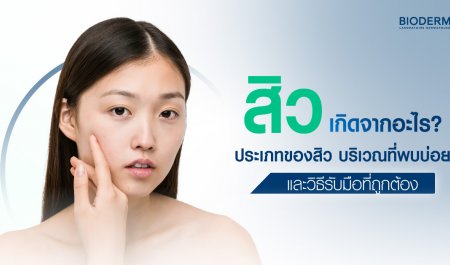สิวเกิดจากอะไร? ประเภทของสิว บริเวณที่พบบ่อย และวิธีรับมือที่ถูกต้อง