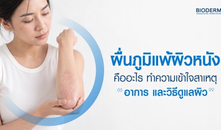 ผื่นภูมิแพ้ผิวหนังคืออะไร ทำความเข้าใจสาเหตุ อาการ และวิธีดูแลผิว